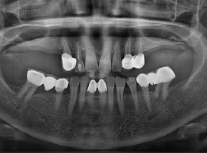 임플란트 전 x-ray